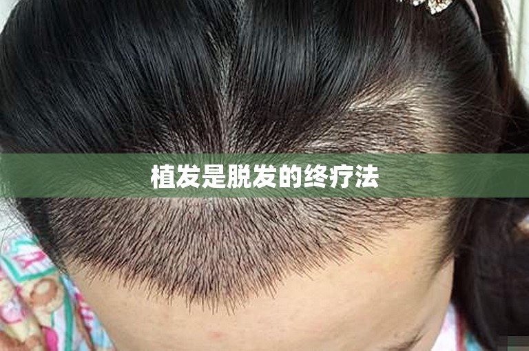 植发是脱发的终疗法