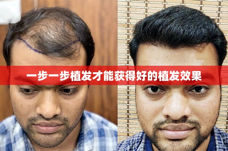 一步一步植发才能获得好的植发效果