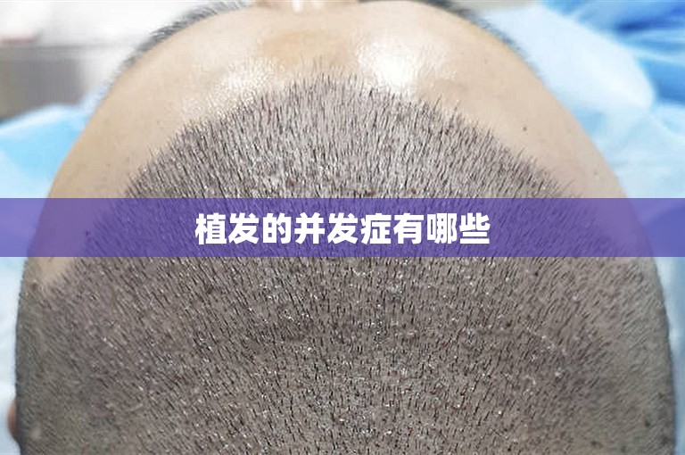 植发的并发症有哪些