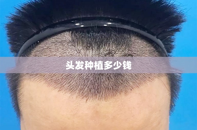 头发种植多少钱
