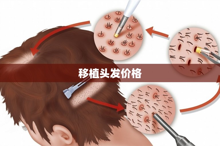 移植头发价格