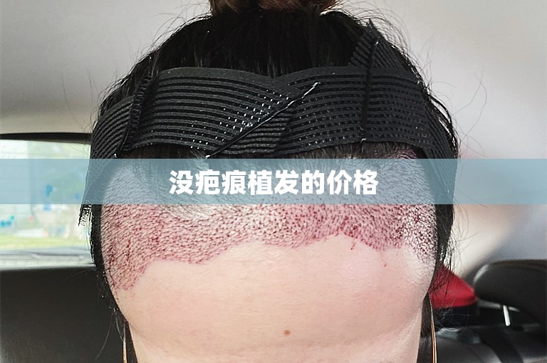 没疤痕植发的价格