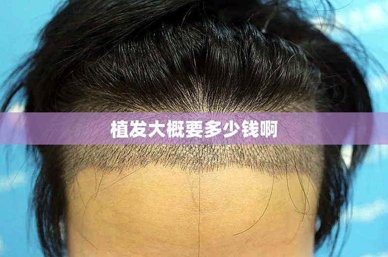 植发大概要多少钱啊