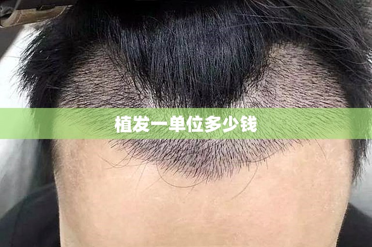 植发一单位多少钱