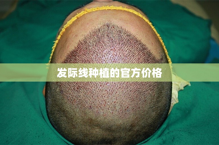 发际线种植的官方价格