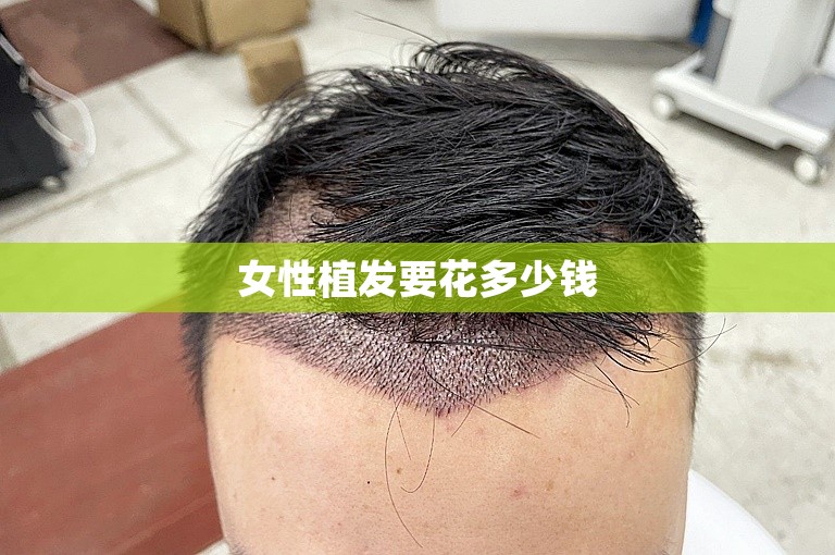 女性植发要花多少钱