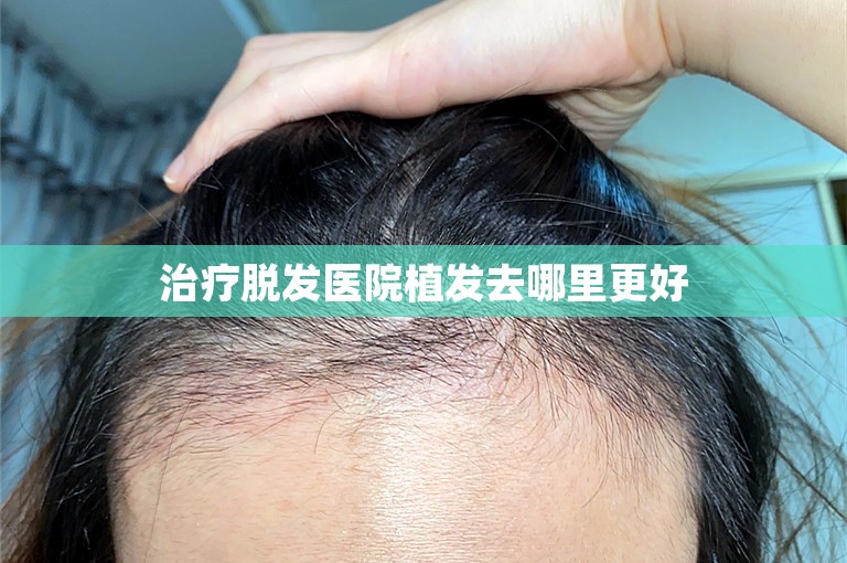 治疗脱发医院植发去哪里更好