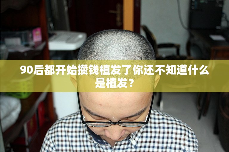 90后都开始攒钱植发了你还不知道什么是植发？
