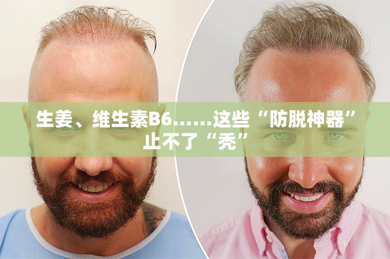 生姜、维生素B6……这些“防脱神器”止不了“秃”