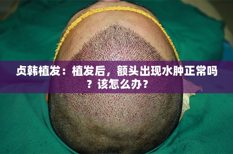 贞韩植发：植发后，额头出现水肿正常吗？该怎么办？