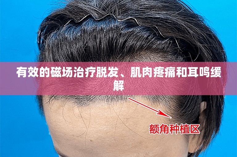 有效的磁场治疗脱发、肌肉疼痛和耳鸣缓解