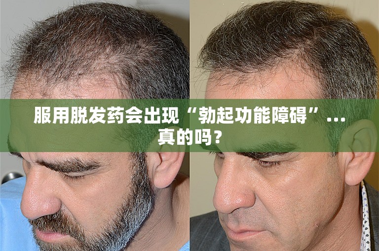 服用脱发药会出现“勃起功能障碍”...真的吗？