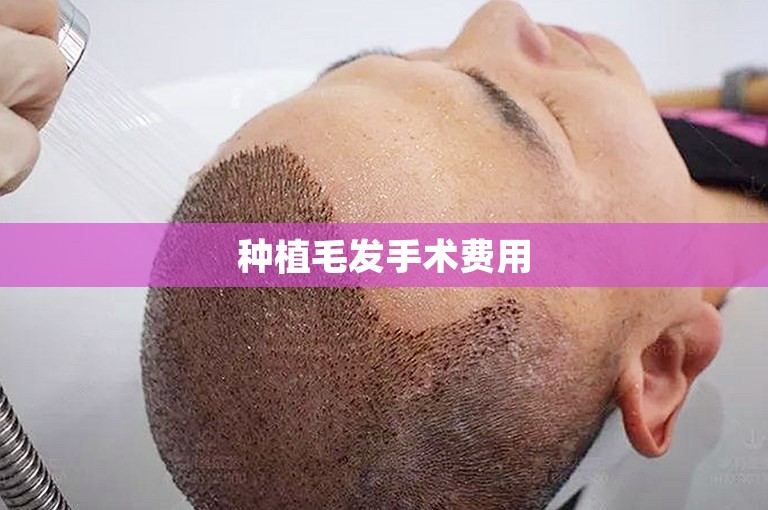 种植毛发手术费用