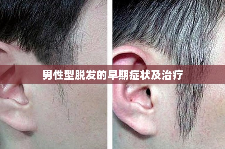 男性型脱发的早期症状及治疗