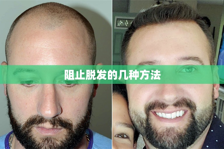 阻止脱发的几种方法