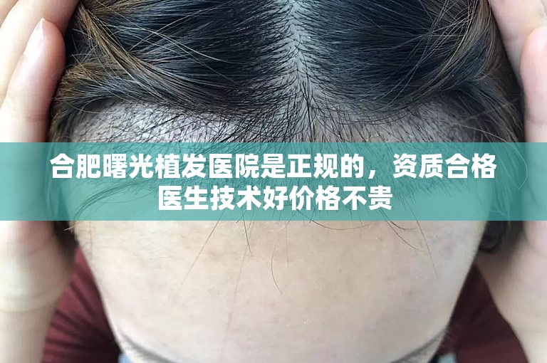 合肥曙光植发医院是正规的，资质合格医生技术好价格不贵