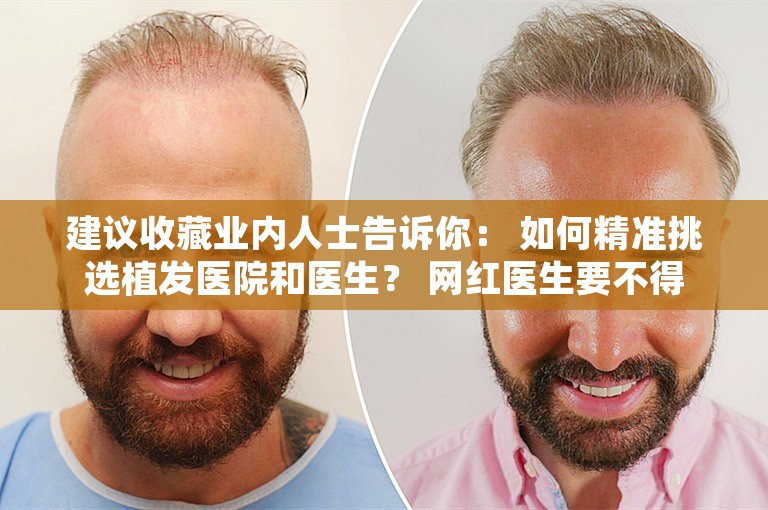 建议收藏业内人士告诉你： 如何精准挑选植发医院和医生？ 网红医生要不得