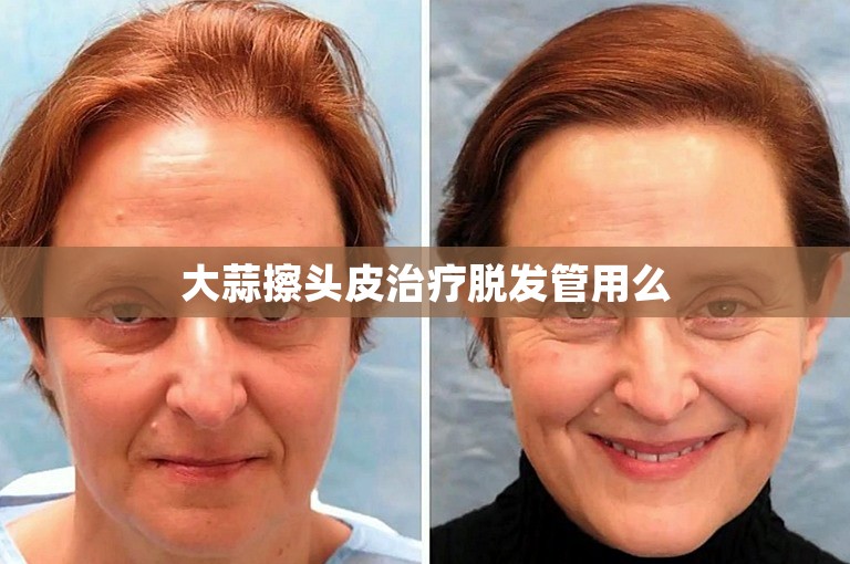 大蒜擦头皮治疗脱发管用么