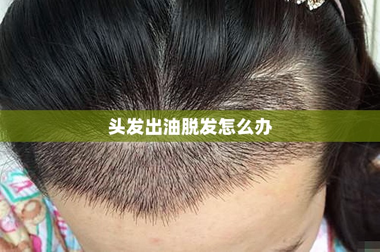 头发出油脱发怎么办