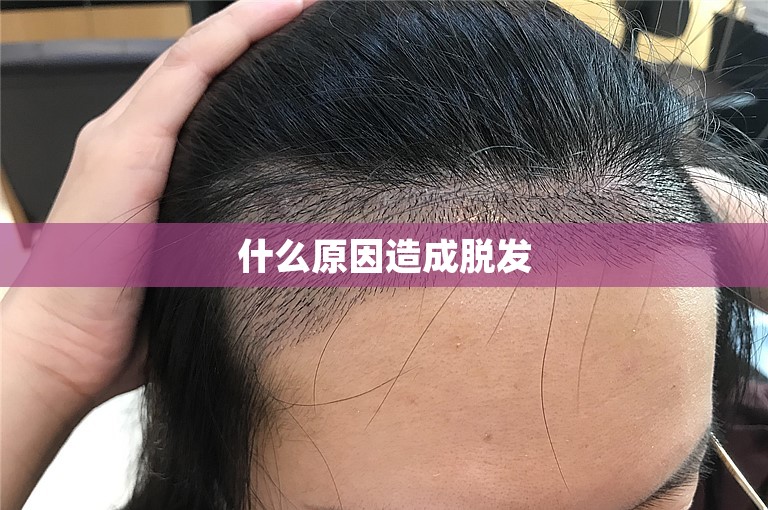什么原因造成脱发