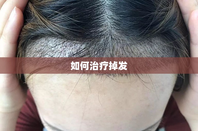 如何治疗掉发