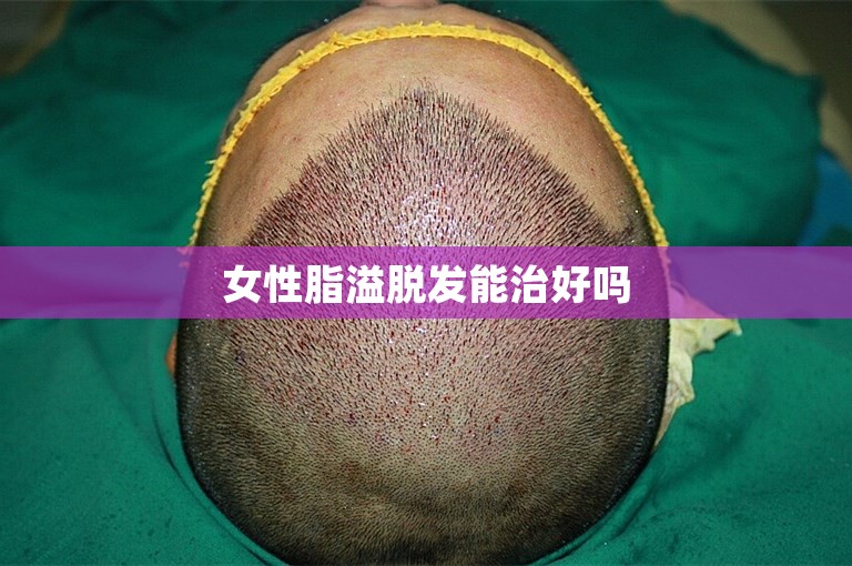 女性脂溢脱发能治好吗