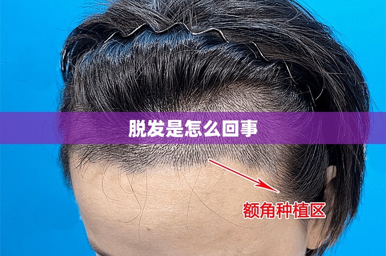 脱发是怎么回事