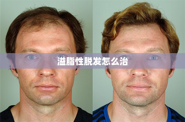 溢脂性脱发怎么治