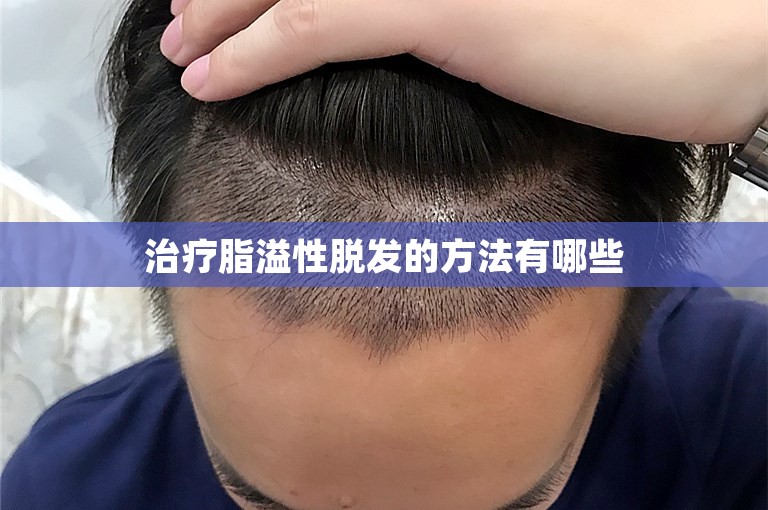治疗脂溢性脱发的方法有哪些