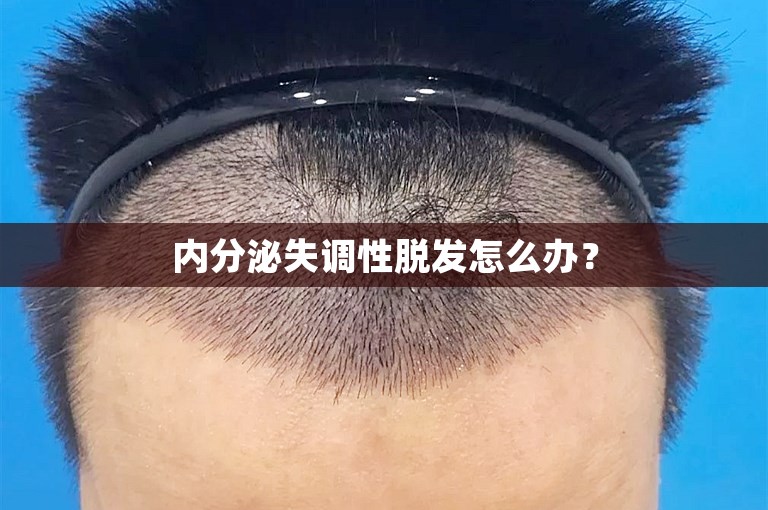 内分泌失调性脱发怎么办？