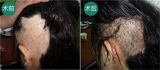 头上有疤植发解决多年困扰