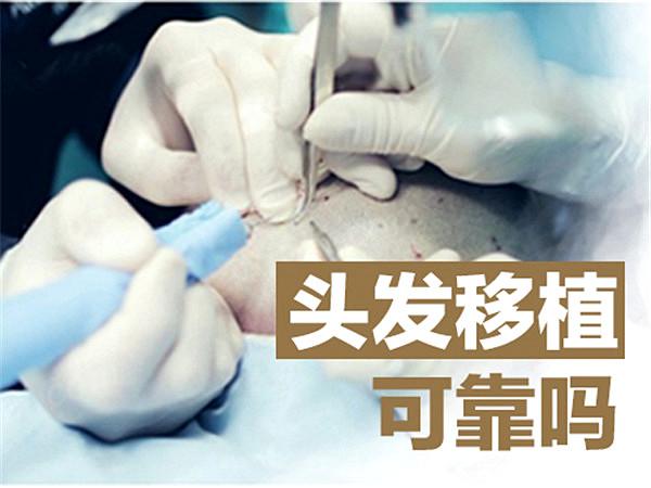 植发靠谱么？