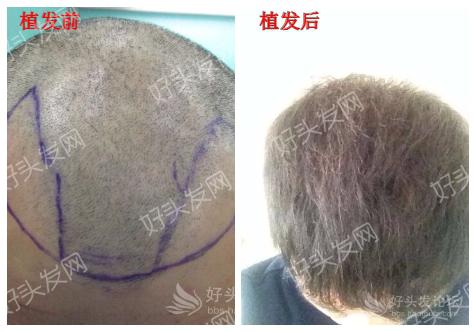 男性植发案例，趁优惠预见最好的自己！