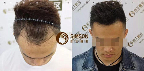 杭州头发怎么加密