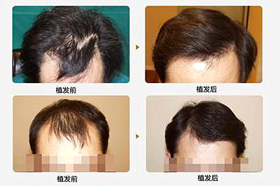 专业疤痕植发要多少钱