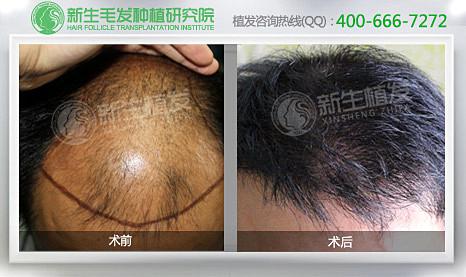 杭州种植头发哪里好