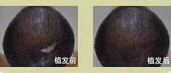头部疤没头发怎么办