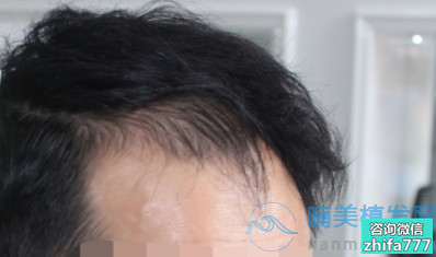 上海新生发际线种植，非常自然