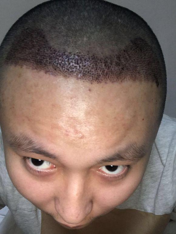 植发解决终生的人生大事