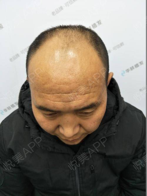 我最开始就选择了专门只做毛发种植的医院