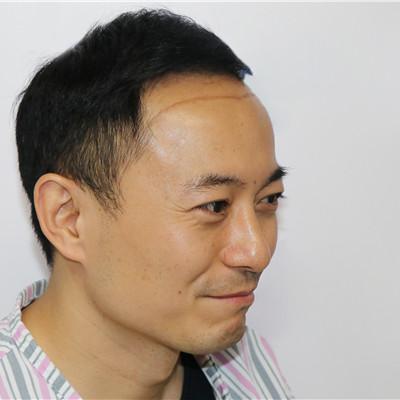 我不是油腻只是有点脱发