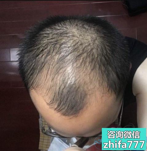 合肥曙光秃顶植发怎么样