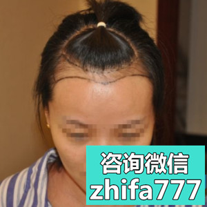 杭州碧莲盛美人尖种植，都说我变漂亮了