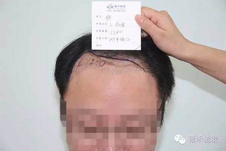 发际线下调头发加密1350单位帅效果！