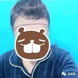 二十几年的大脑门发际线植发术后9个月记录