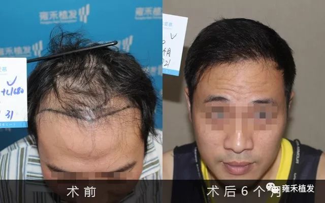 他上海植发3300单位年轻了十岁