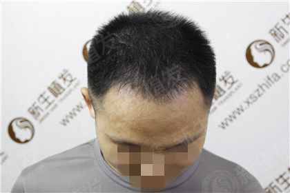 植发案例脱发之痛不复存在！