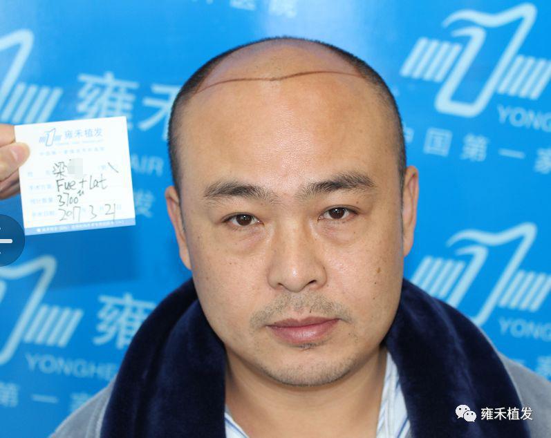 郑州雍禾植发为梁先生种植3700单位