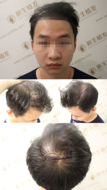 发友自述植发寻遍各种治脱大招最终如愿恢复形象