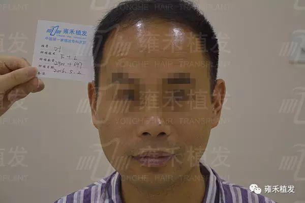 杭州雍禾植发为叶先生种植3610单位7个月效果